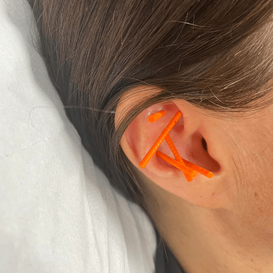 Close-up of fine acupuncture needles in place in the outer ear