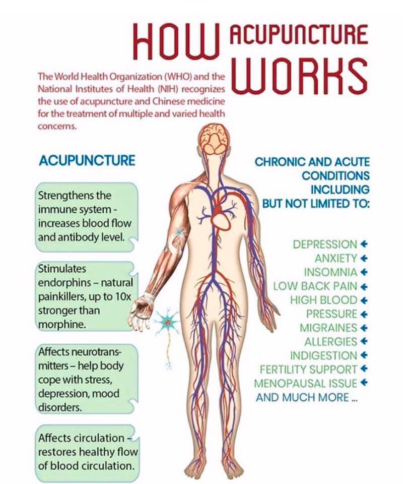 Acupuncture treatment at Deanna Thomas, Middlesbrough