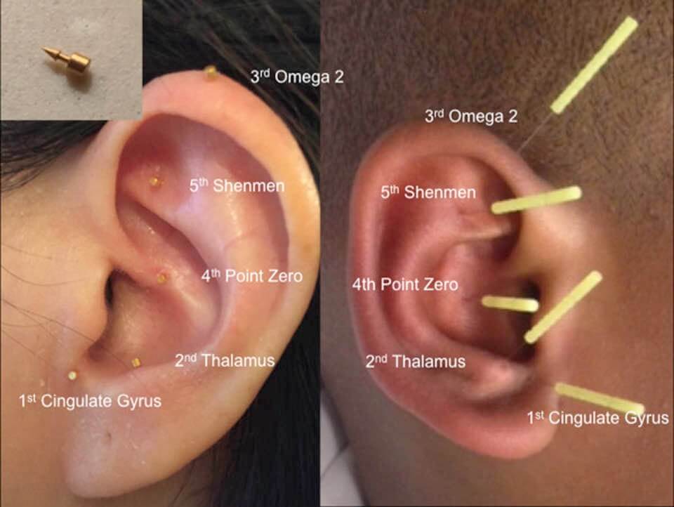 ASP semi-permanent needles used in battlefield acupuncture
