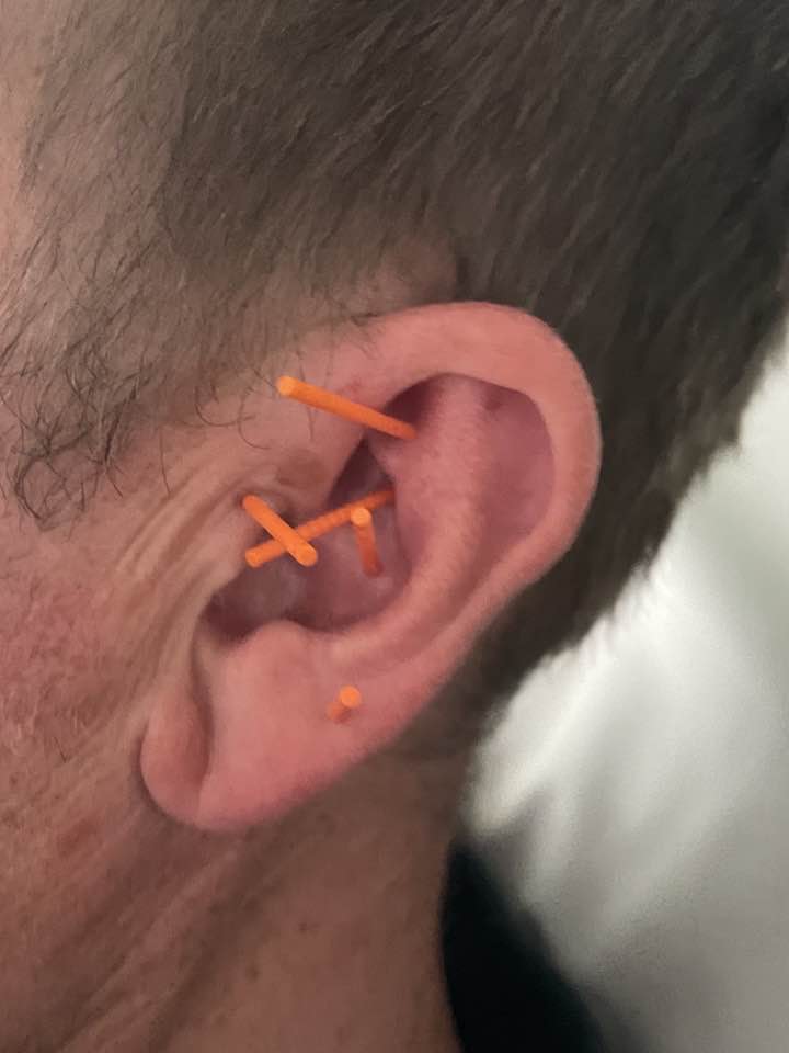 Client relaxing during Relax and Reset ear acupuncture massage session Middlesbrough