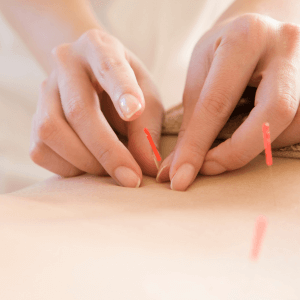 Fine sterile acupuncture needles used in women's health treatment at Deanna Thomas clinic Middlesbrough