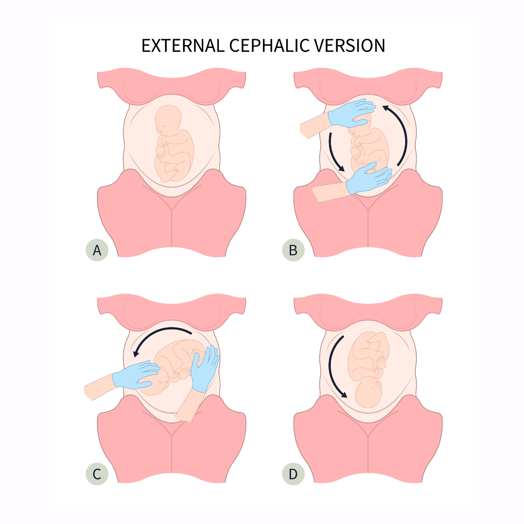 External cephalic version ECV procedure for turning a breech baby