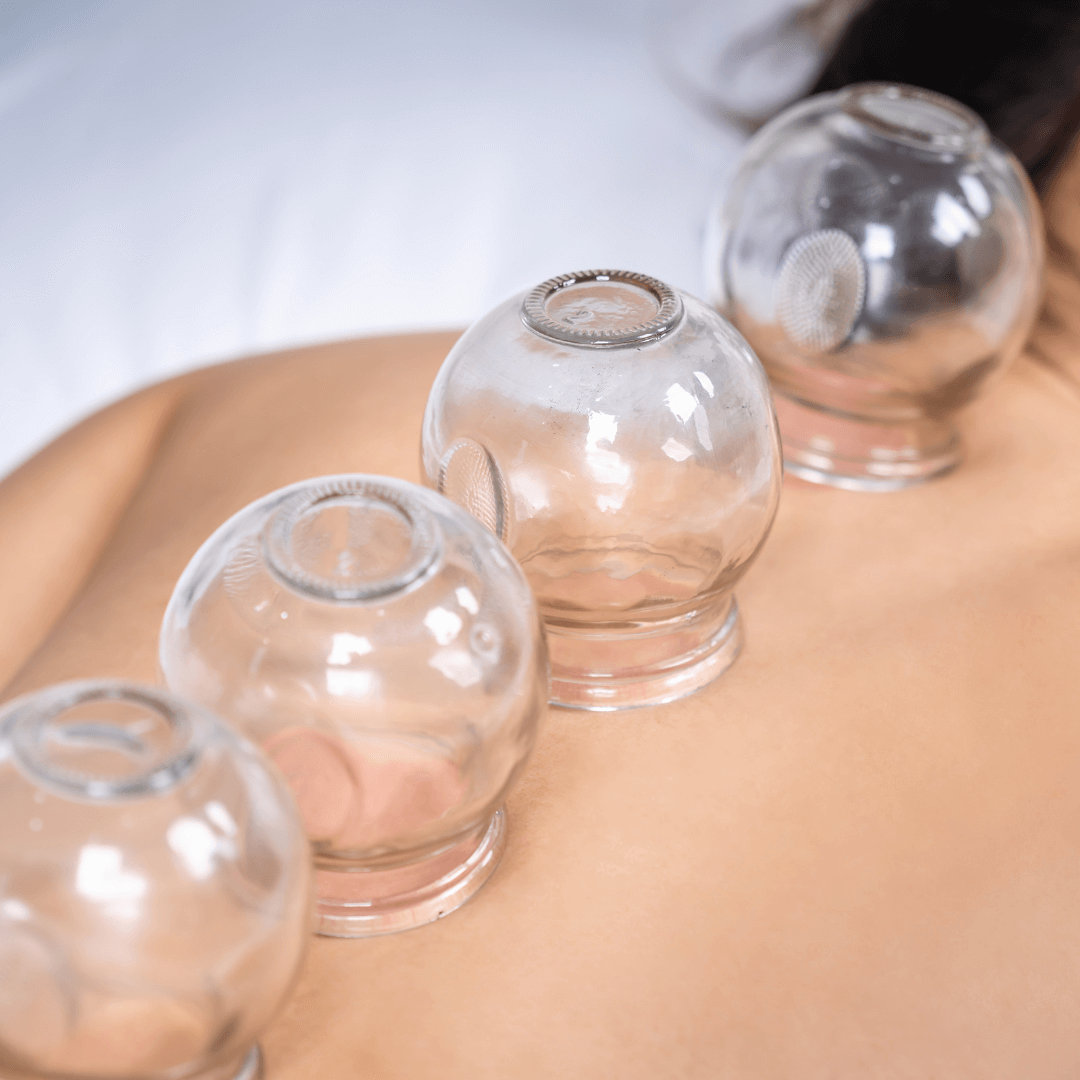 Cupping therapy at Deanna Thomas Acupuncture Middlesbrough to improve circulation and wellbeing