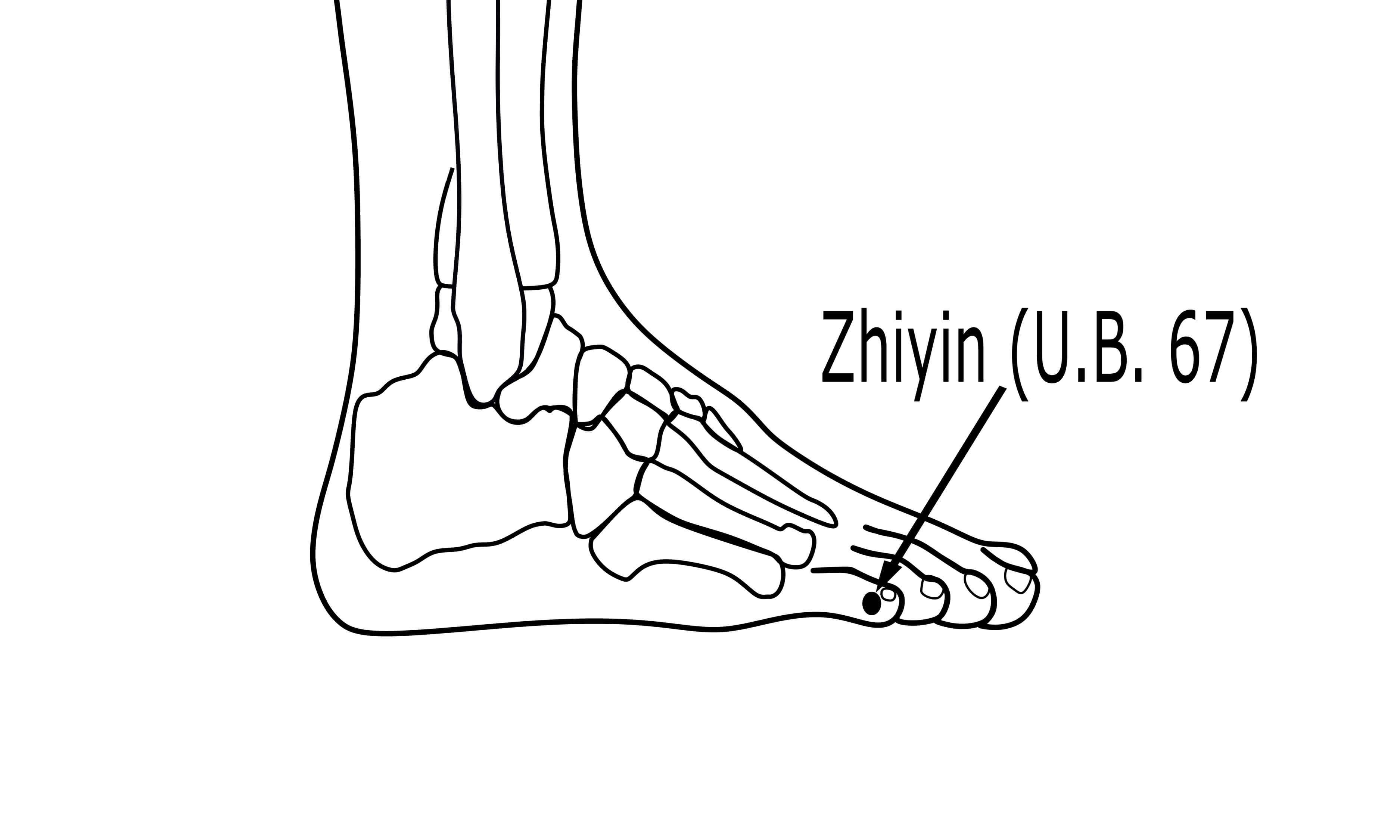 UB67 acupuncture point on the little toe used in moxibustion for breech presentation