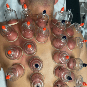Cupping therapy treatment at Deanna Thomas clinic Middlesbrough