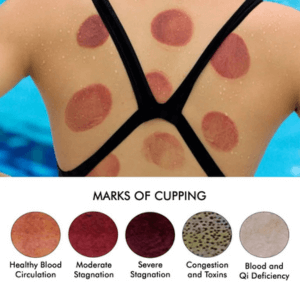 Cupping marks after treatment at Deanna Thomas Acupuncture Middlesbrough