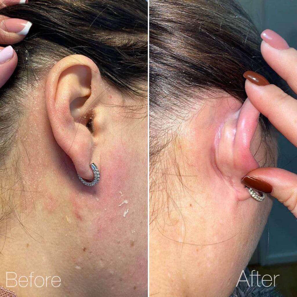 "Before and after photos of seborrheic dermatitis treatment using PRP therapy at Helena Aesthetics Clinic in Middlesbrough, showing clear and healthy skin behind the ear after treatment."