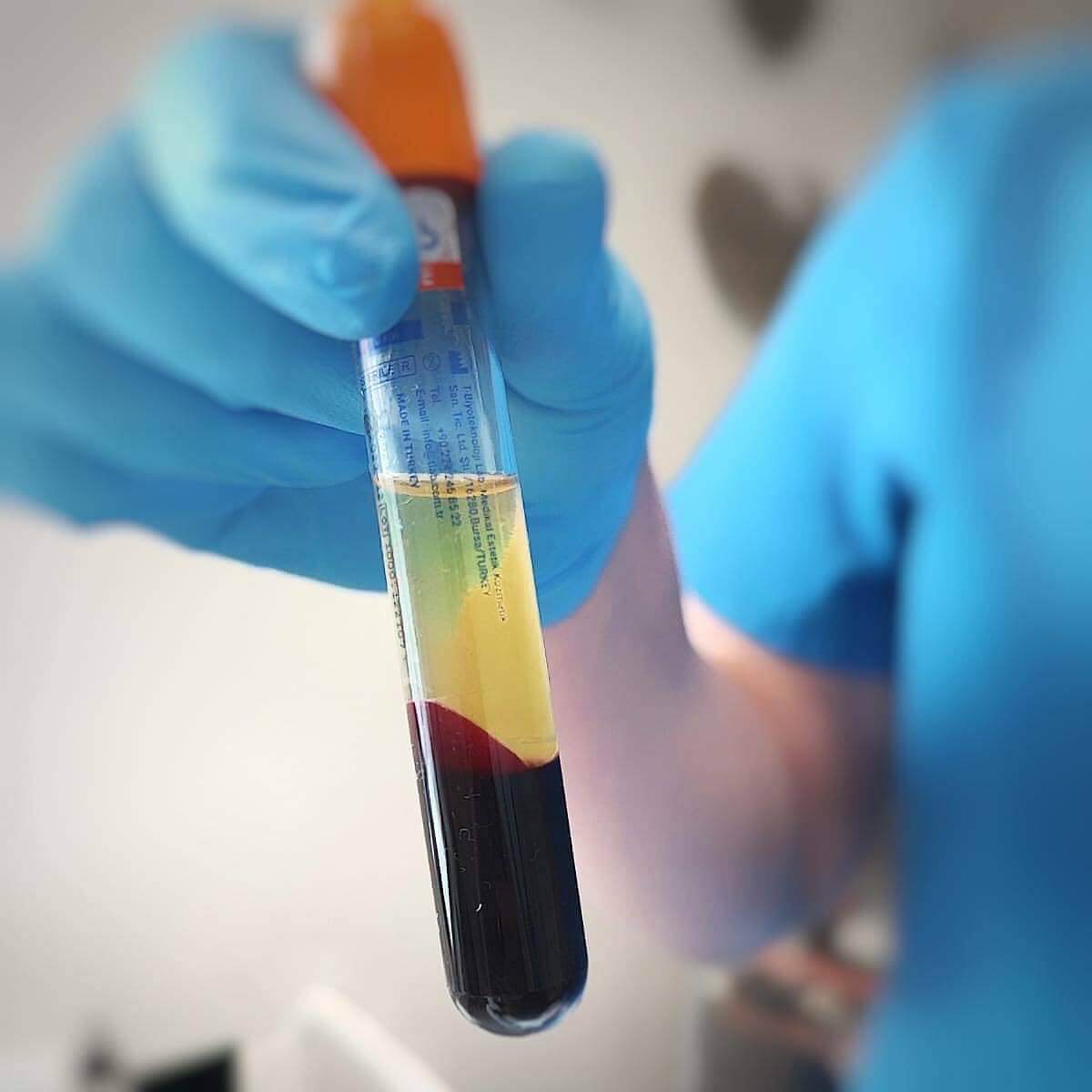 "Platelet-rich plasma (PRP) preparation at Helena Aesthetics Clinic in Middlesbrough, showcasing a blood sample separated into plasma and red blood cells for skin rejuvenation."