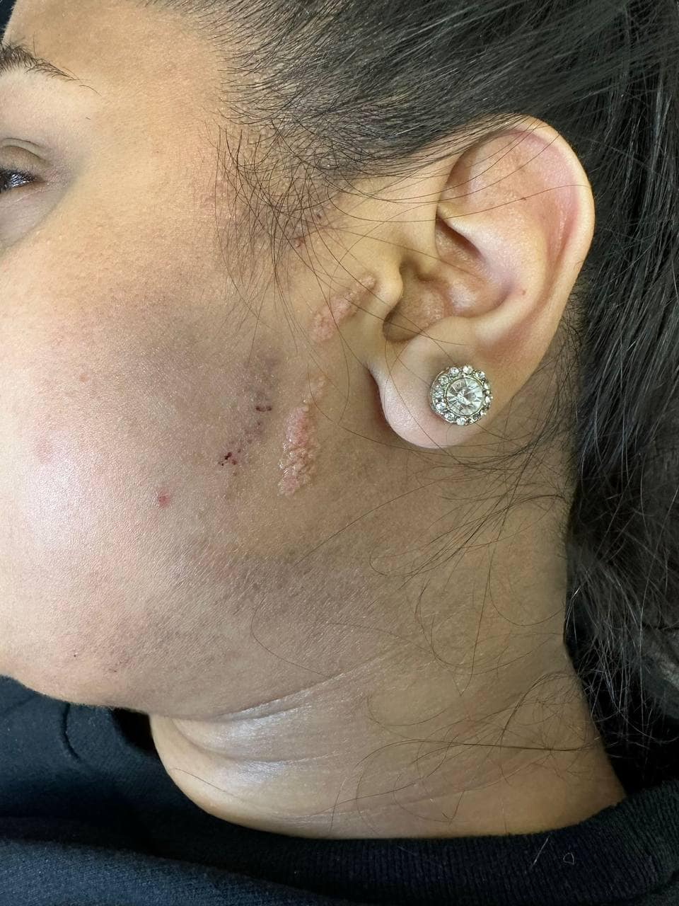 "Facial skin tags treated at Helena Aesthetics Clinic Middlesbrough, highlighting flawless results from diathermy skin tag removal."