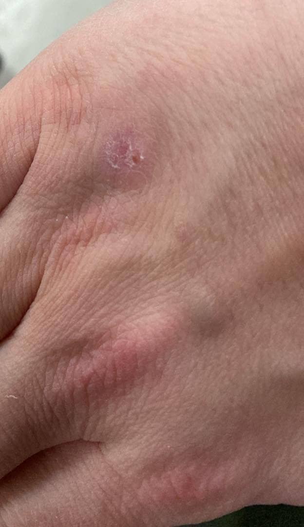 "Multiple skin tags on hand removed using diathermy at Helena Aesthetics Clinic in Middlesbrough, delivering smooth results with professional care."