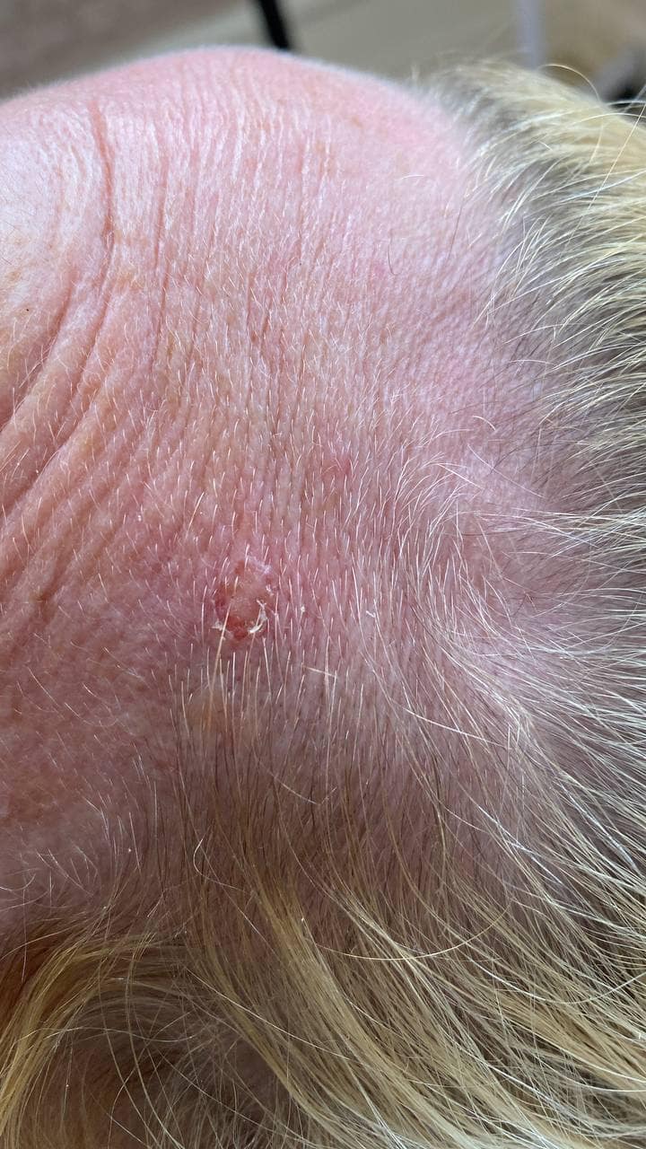 "Skin tag on forehead treated with diathermy at Helena Aesthetics Clinic Middlesbrough, showing effective removal with no scarring."