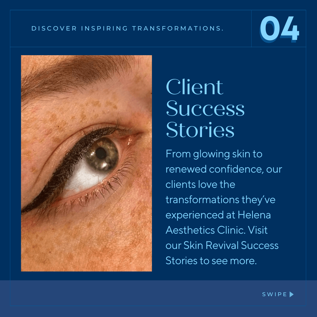 "Close-up of a client’s glowing skin after a treatment at Helena Aesthetics Clinic in Middlesbrough, showcasing successful skin rejuvenation."