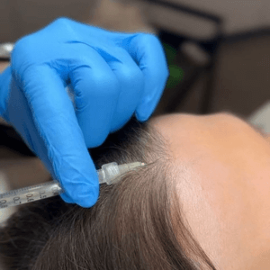 Helena performing PRP therapy for hair restoration at Helena Aesthetics Clinic in Middlesbrough, using platelet-rich plasma injections to stimulate growth and rejuvenate the scalp.