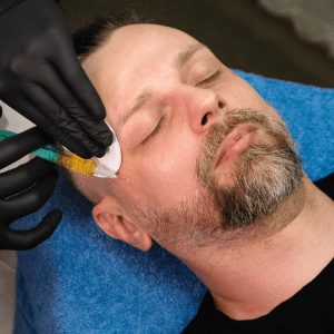 "Male client receiving PRP treatment at Helena Aesthetics Clinic in Middlesbrough, showcasing platelet-rich plasma therapy for hair loss and scalp rejuvenation."