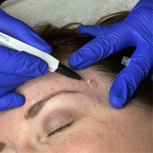 "Close-up of a professional diathermy skin tag removal procedure at Helena Aesthetics Clinic in Middlesbrough, demonstrating precise and effective treatment."