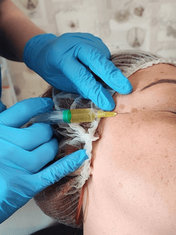 "Helena performing precise PRP injections on a client’s face during a vampire facial treatment at Helena Aesthetics Clinic in Middlesbrough."