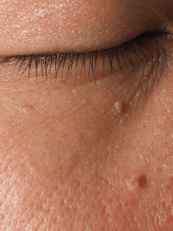"Close-up of facial skin tags near the eye, showing common skin growths treated safely at Helena Aesthetics Clinic Middlesbrough using diathermy technology."